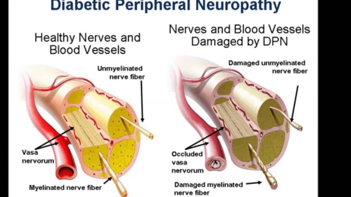 Adverse Reactions in Pooled Placebo-Controlled Trials in Postherpetic Neuralgia